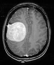 Tumor Present